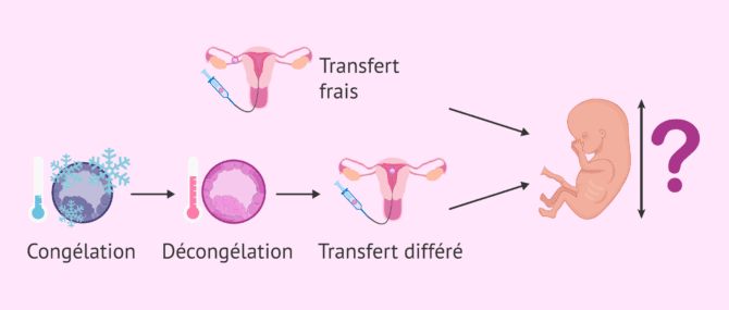 Imagen: Transfert frais ou différé et croissance fœtale
