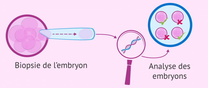 Imagen: Technique de procréation assistée utilisée dans le processus de Fécondation In Vitro (FIV)