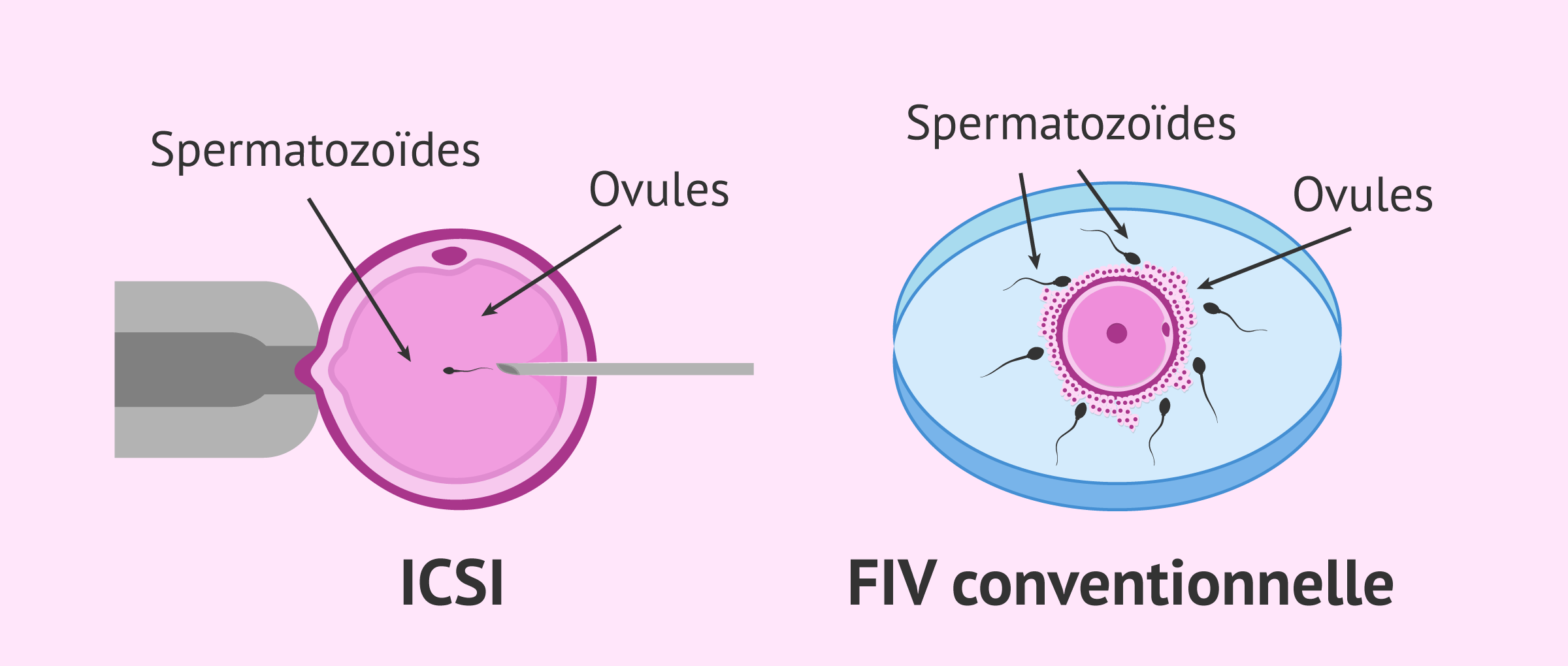 Imagen: Comparaison entre la FIV conventionnelle et l'ICSI