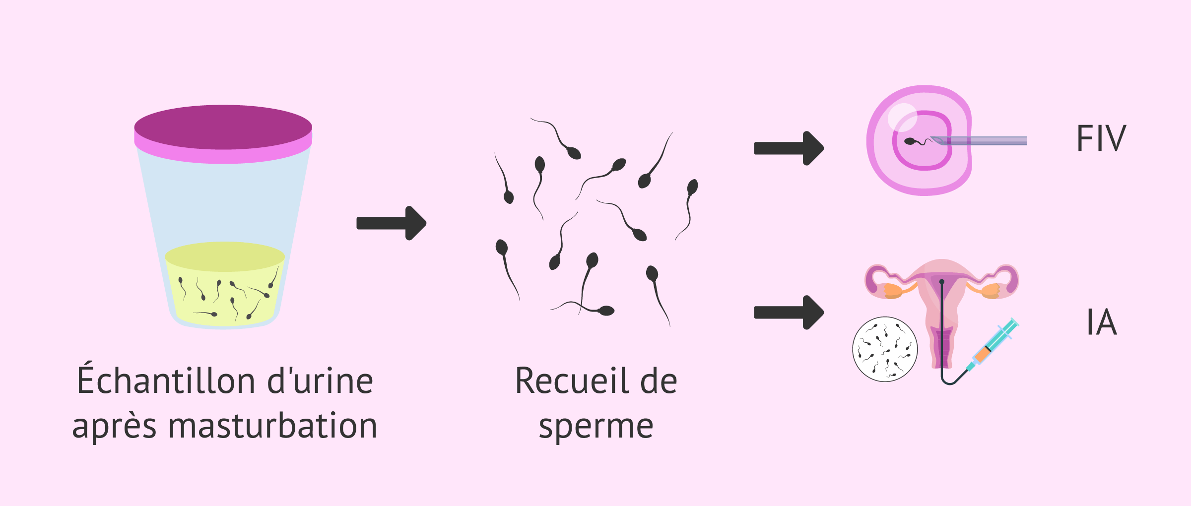 Éjaculation rétrograde définition, causes et traitement