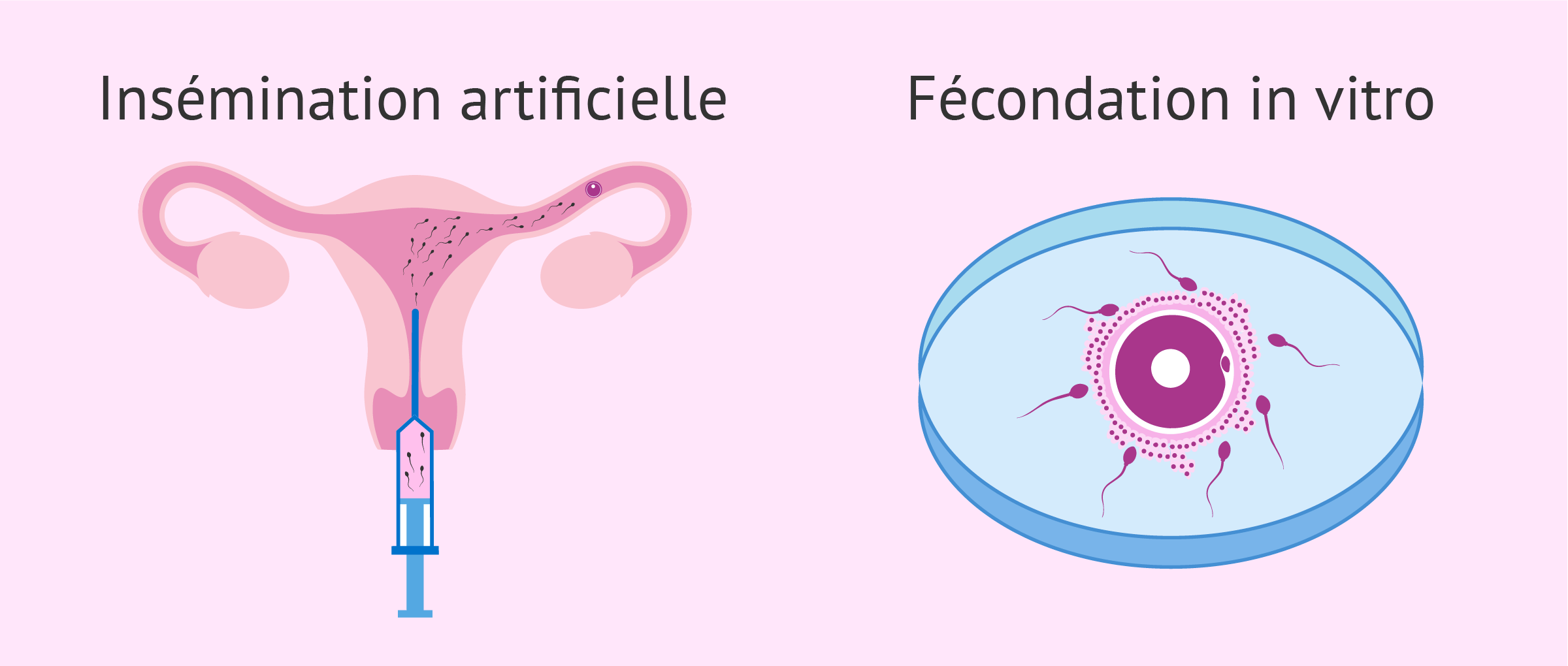 Procréation Médicalement assistée