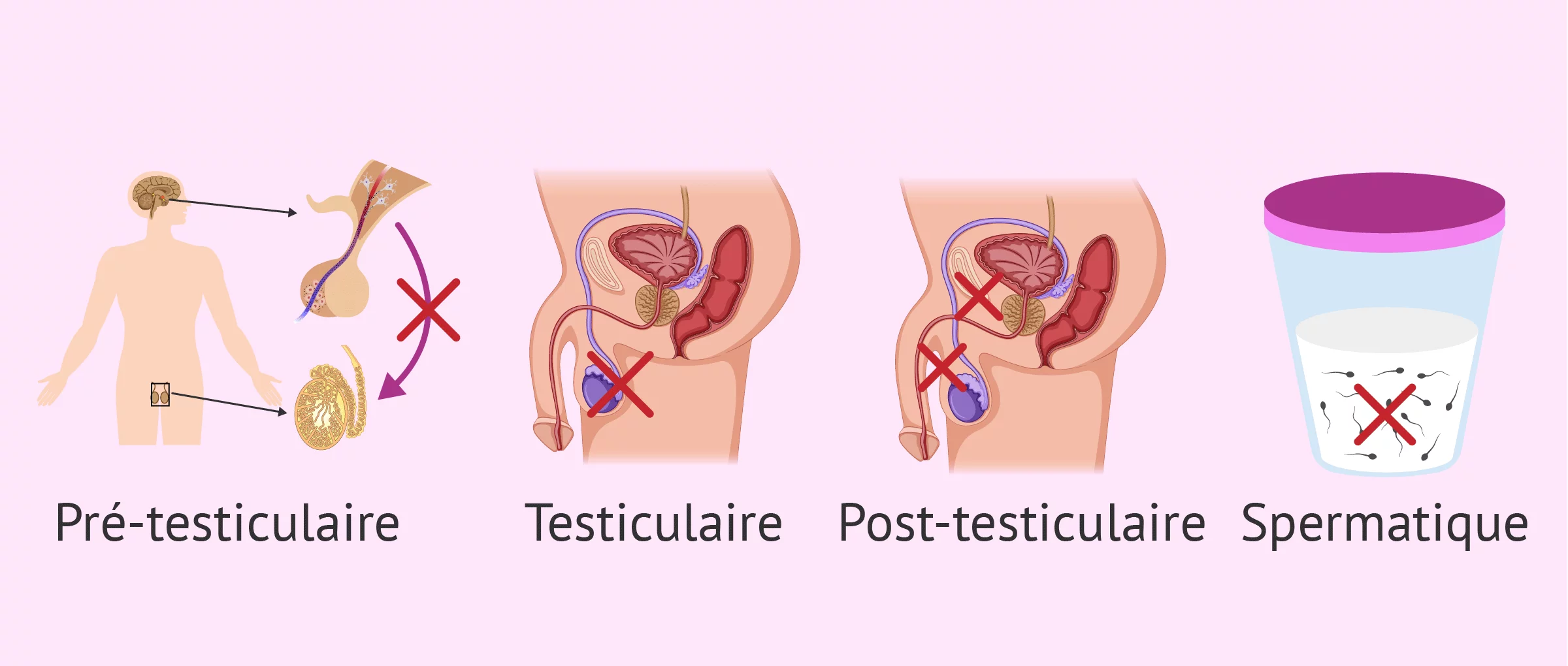 Stérilité masculine: définition, symptômes et causes