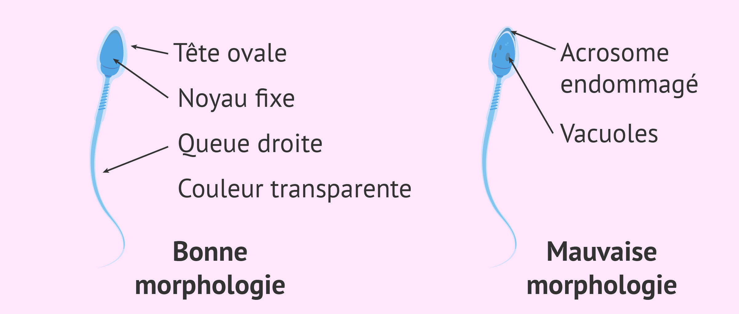 Sélection du spermatozoïde avec la meilleure morphologie