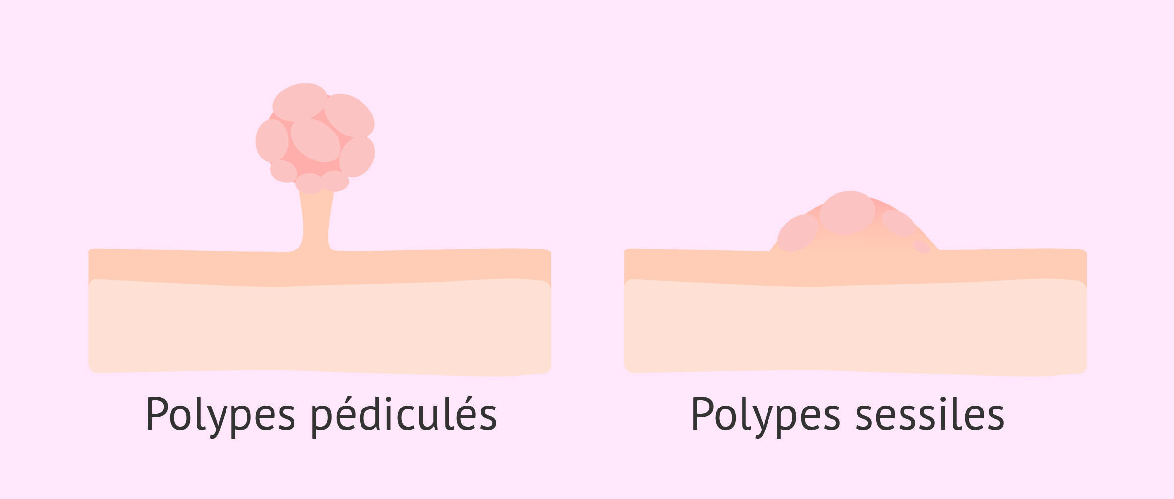 Les polypes utérins