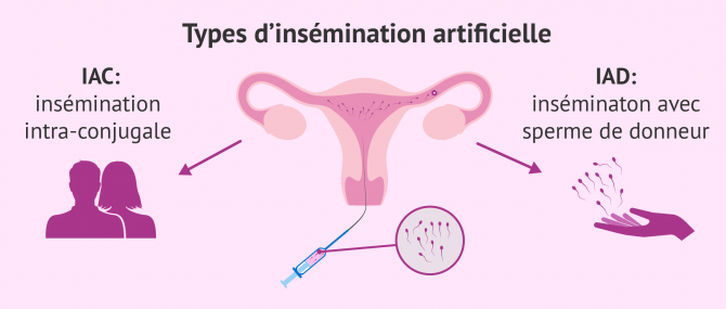 Types d'insémination artificielle