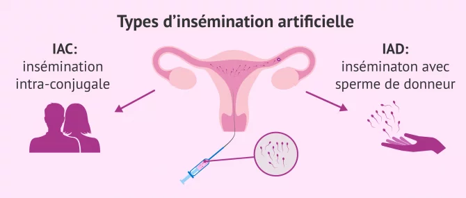 Types d'insémination artificielle