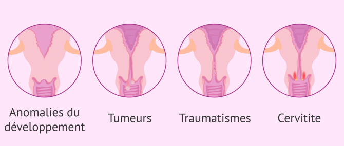 Altérations structurelles du cervix