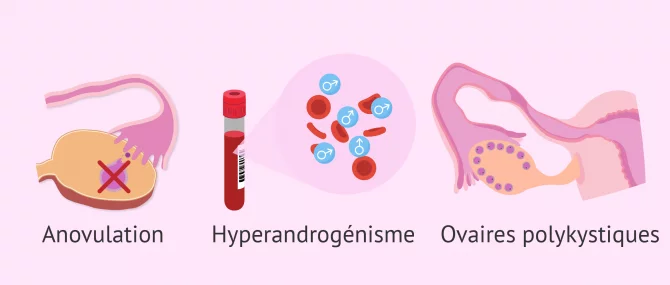 Diagnostic du syndrome de l'ovaire polykystique