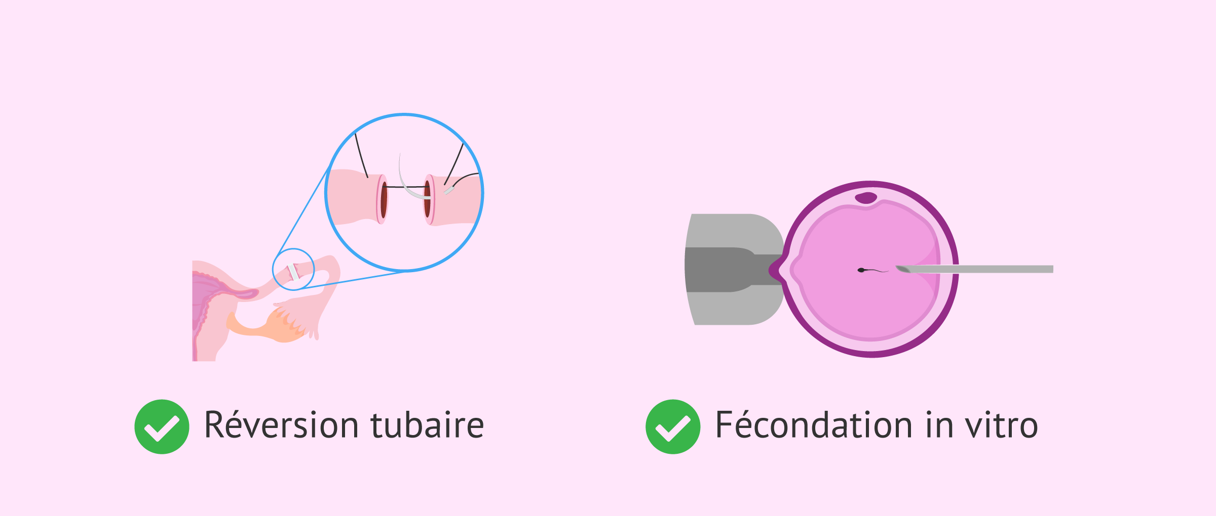 Imagen: Les options de grossesse après une ligature des trompes