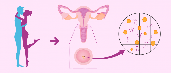 Test post-coïtal pour évaluer le facteur cervical