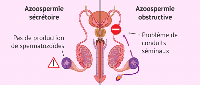 Azoospermie sécrétoire et obstructive: causes et diagnostic