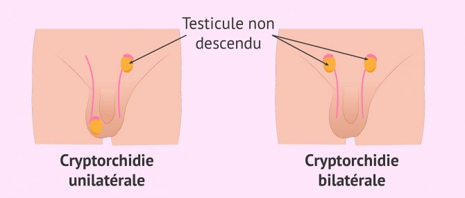 La cryptorchidie