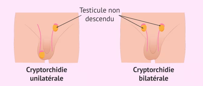 Imagen: La cryptorchidie