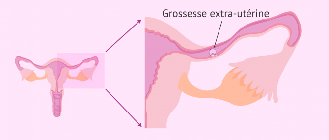 Imagen: grossesse extra-uterine en ia