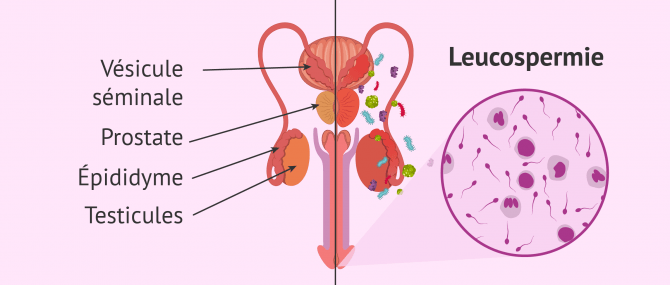 Leucocytes dans le sperme: spermogramme, spermoculture et traitement