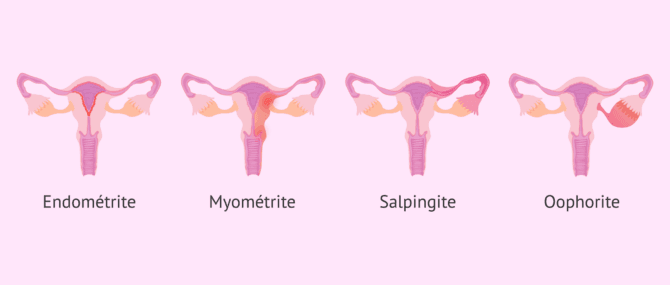 Imagen: Inflammation des trompes de Fallope