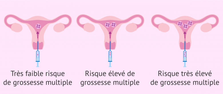 Risque de grossesse multiple en fonction du nombre d'embryons.