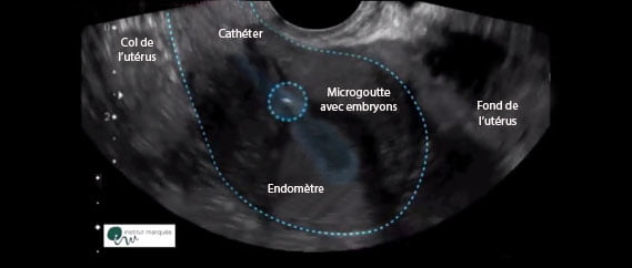 Transfert Embryon Echographie du transfert d'embryon