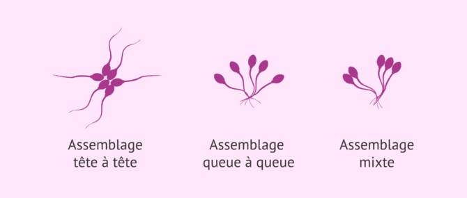 Imagen: Types d'agglutination des spermatozoïdes