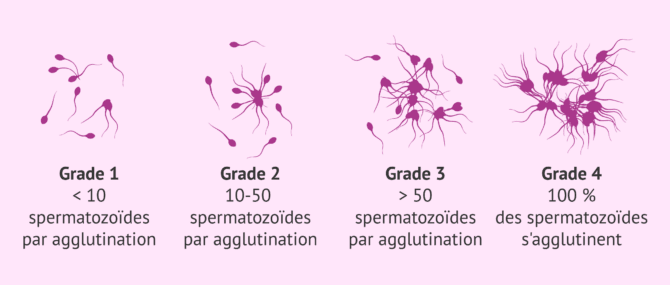Imagen: Différents degrés d'agglutination des spermatozoïdes