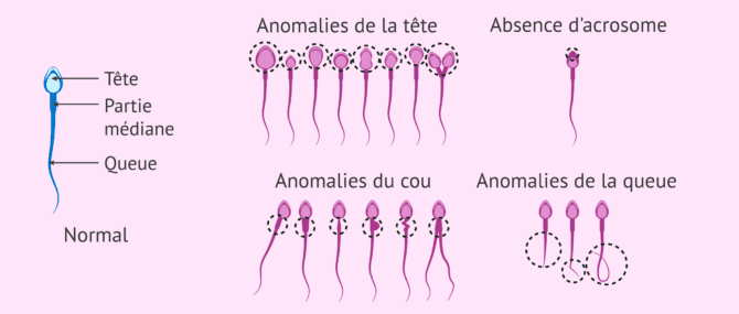 Imagen: Qu'est-ce qu'un spermatozoïde anormal?