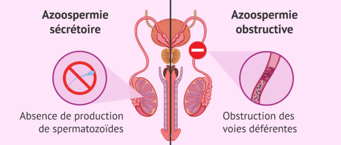 Imagen: Différence entre les types d'azoospermie