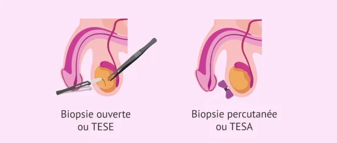Imagen: Méthodes de prélèvement d'une biopsie testiculaire