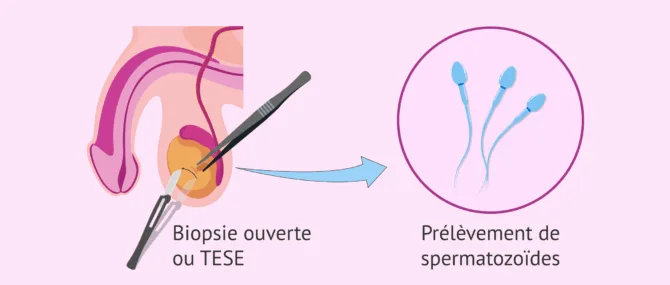 Imagen: Biopsie testiculaire ouverte (TESE)