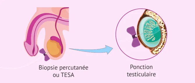 Imagen: Biopsie testiculaire percutanée (TESA)