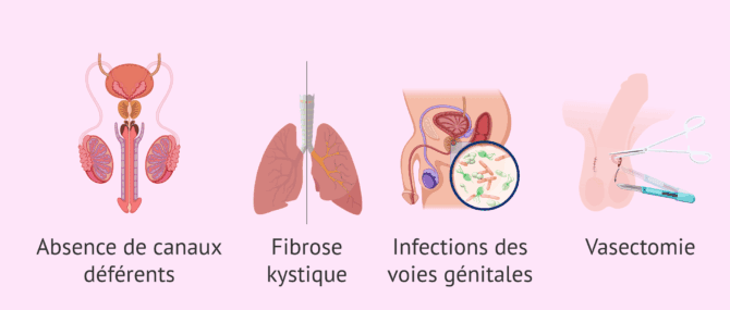 Imagen: Quand une biopsie testiculaire est-elle réalisée?