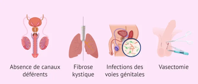 Imagen: Quand une biopsie testiculaire est-elle réalisée?