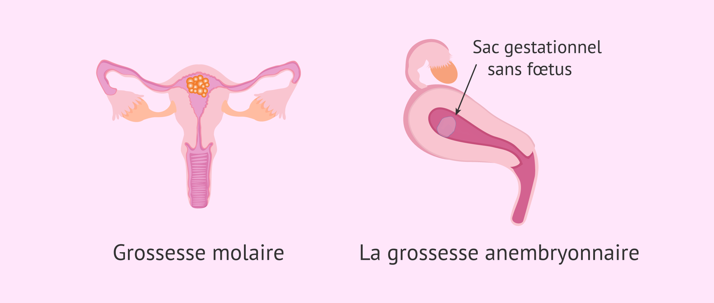 grossesse-molaire-anembryonnaire