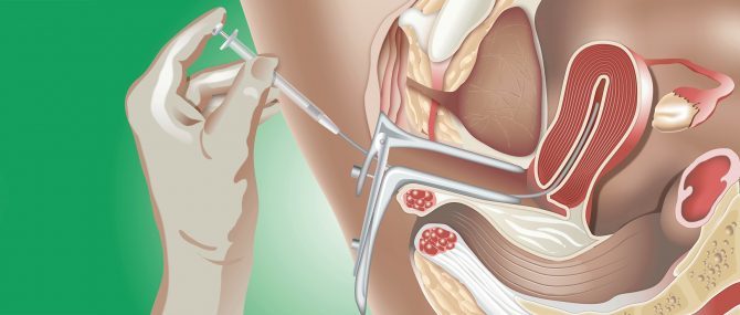 Insémination avec don de sperme