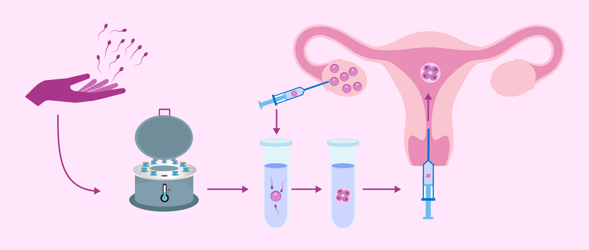 Procédure de fécondation in vitro avec sperme de donneur