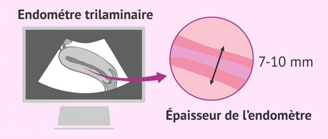 Endomètre épaissi favorable à la nidation