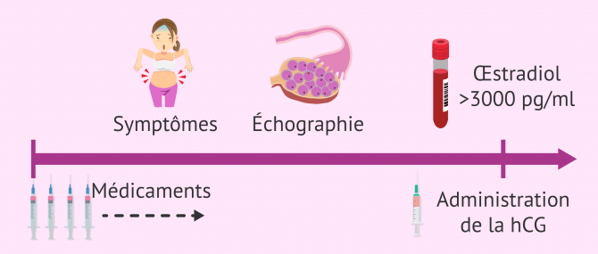 Faire un don d’ovocytes: possibles risques pour la donneuse