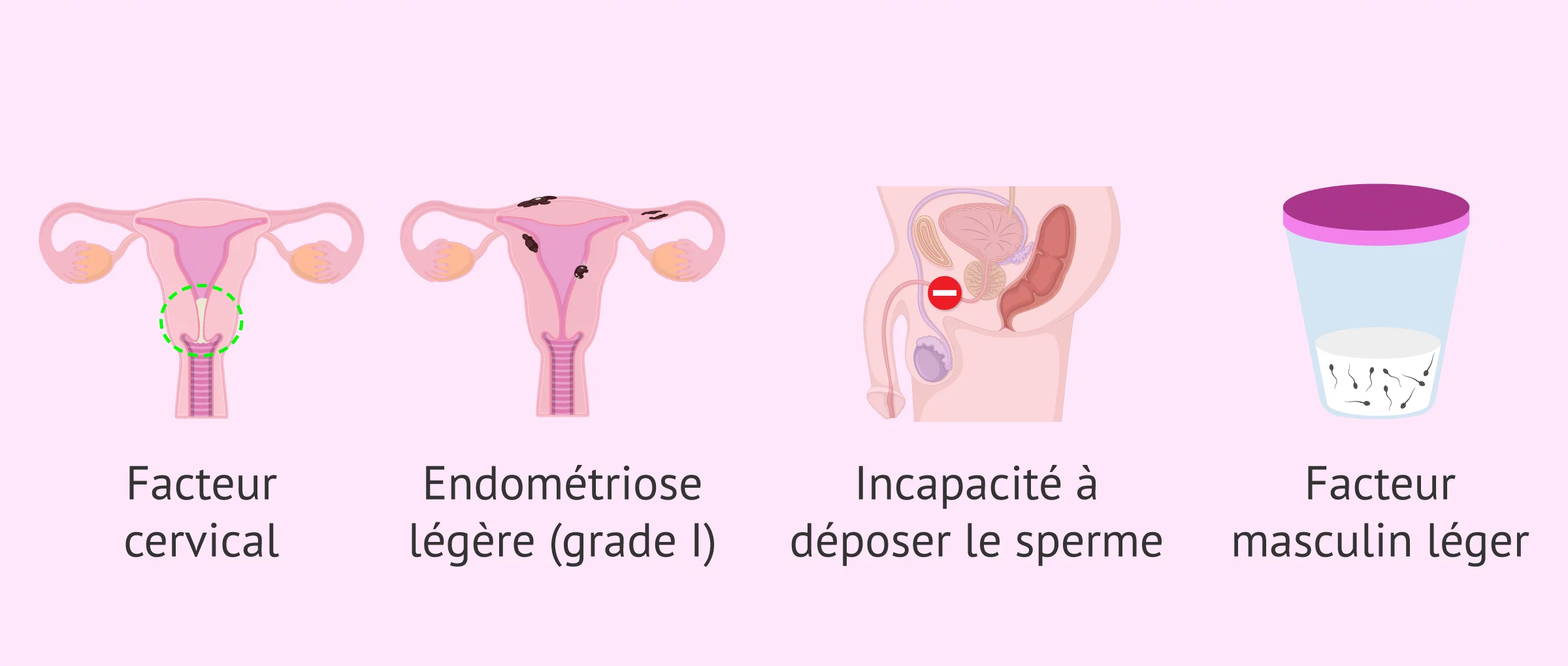 Imagen: Quand l'IA conjugale est-elle indiquée ?
