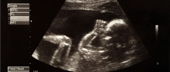 Échographie du foetus