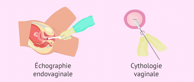 Examen d'infertilité en cabinet gynécologique