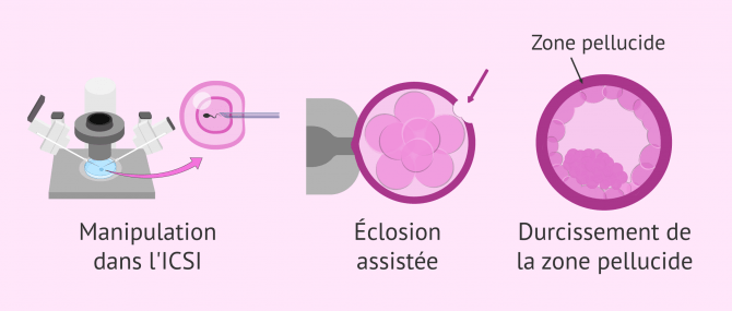 Imagen: Qu'est-ce qui influence la probabilité d'avoir des jumeaux lors d'une FIV?