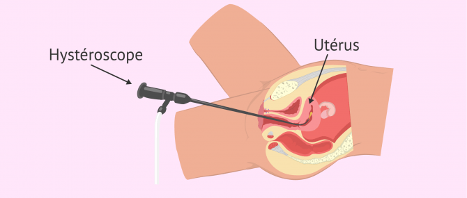Hystéroscopie pour évaluer la fertilité de la femme