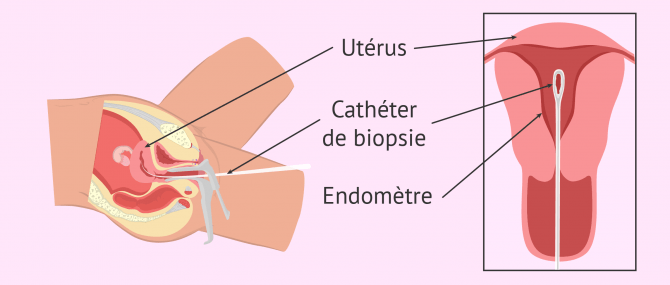 Réalisation de biopsie endométriale