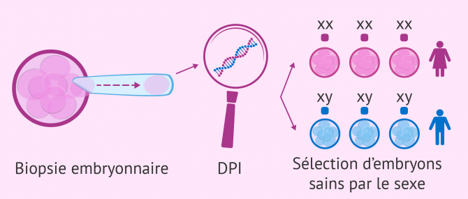 Sélection du sexe par DPI