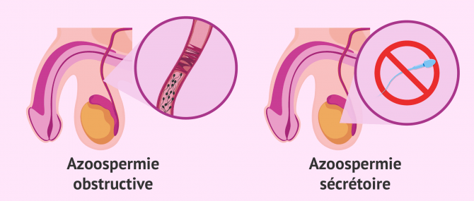 Types d'azoospermie qui provoquent l'infertilité