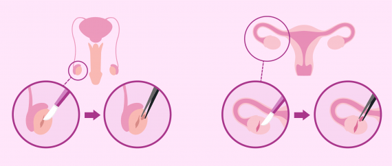 Extraction du tissu ovarien et testiculaire par biopsie