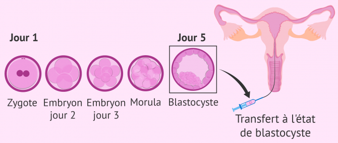 Culture séquentielle pour le transfert embryonnaire