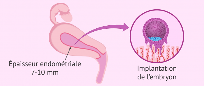 Épaisseur de l'endomètre et grossesse