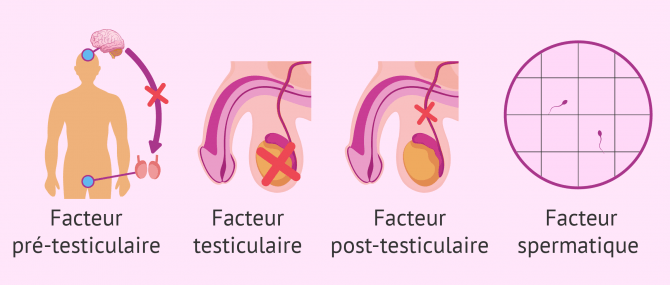 Les facteurs de la stérilité masculine