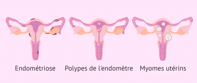 Pathologies qui affectent l'endometre