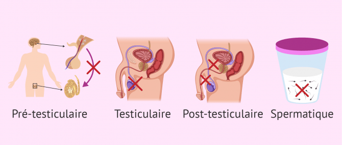 Principaux facteurs affectés par l'infertilité masculine